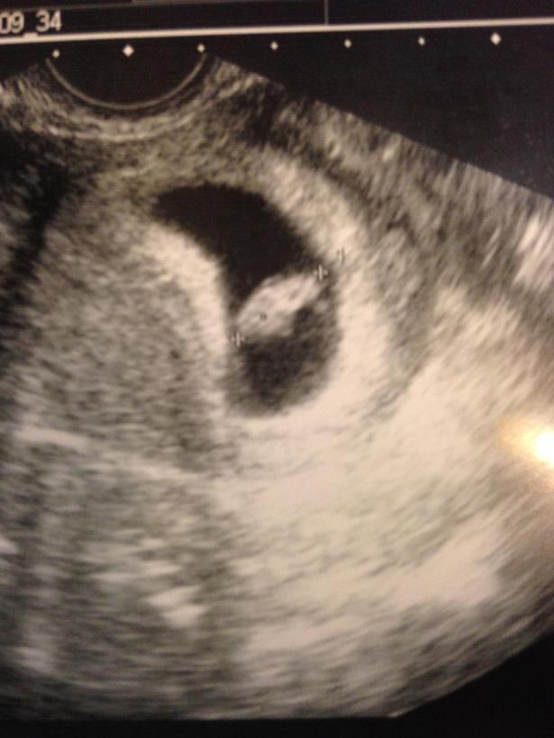 Tiffany Lakosky’s first sonogram showing a positive pregnancy. (Image courtesy Tiffany Lakosky)